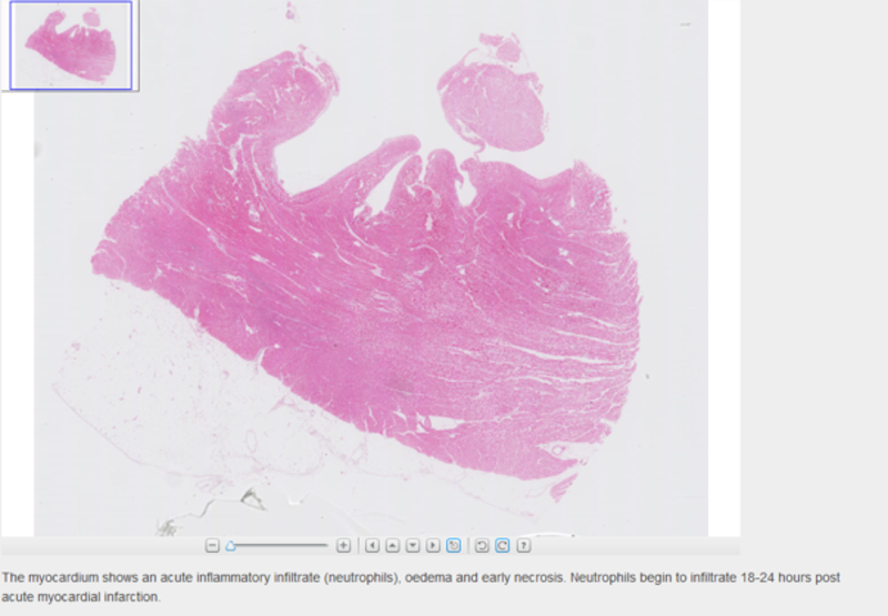 Digital image of an acute myocardial infarction in the Virtual microscopy tool in VLE.
